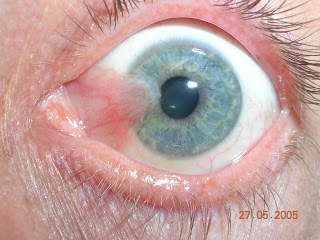 Chirurgia tumorilor parbebrale si conjuctivale