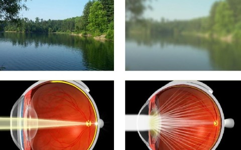 Chirurgia cataractei