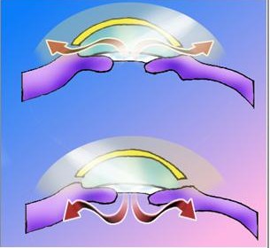 Chirurgia glaucomului